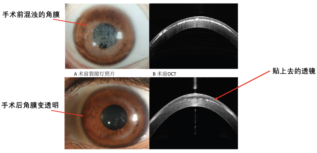 今天全飞秒近视手术来源的角膜基质透镜保存与再利用,已成全球眼科