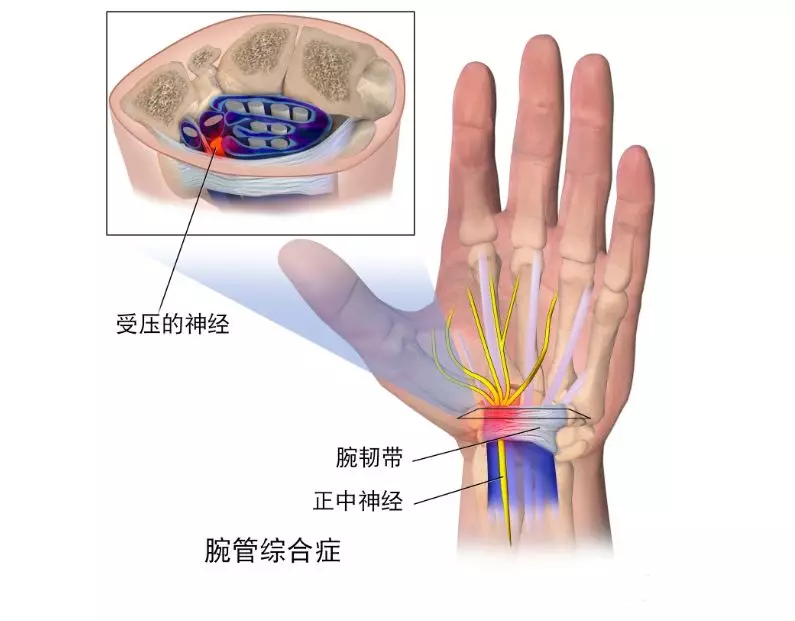 睡觉手麻要小心