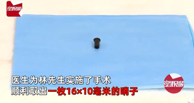 男子6岁时吞下一个哨子怕被骂瞒了20年！如今咳得不行了才做手术取出休闲区蓝鸢梦想 - Www.slyday.coM