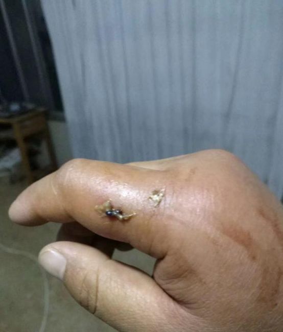 被马蜂蛰伤后请别慌,做好5步,帮助处理伤口