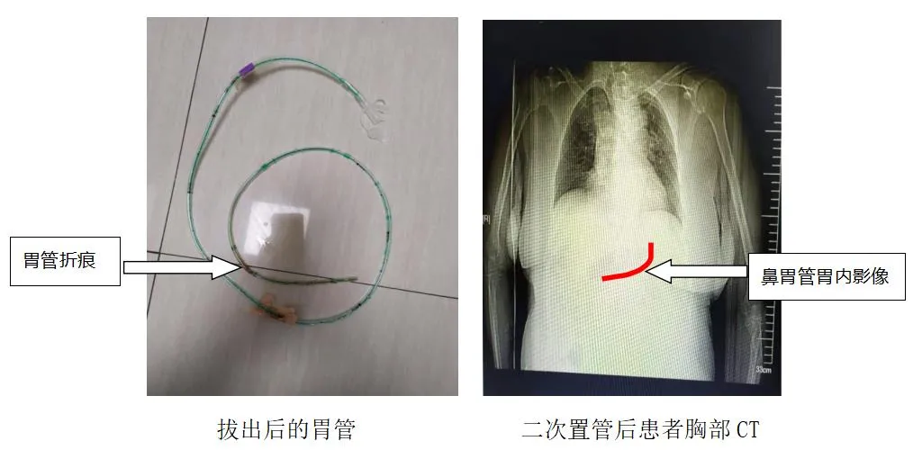 鼻胃管胃内反折!究竟是哪里出了错?