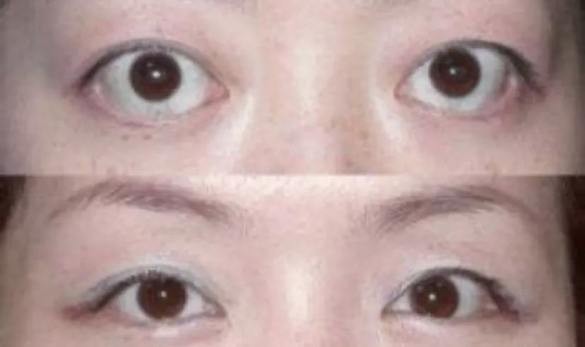 眼眶骨壁减压就是破坏部分眶骨结构再重组,从而增加眶骨容积,让眼球