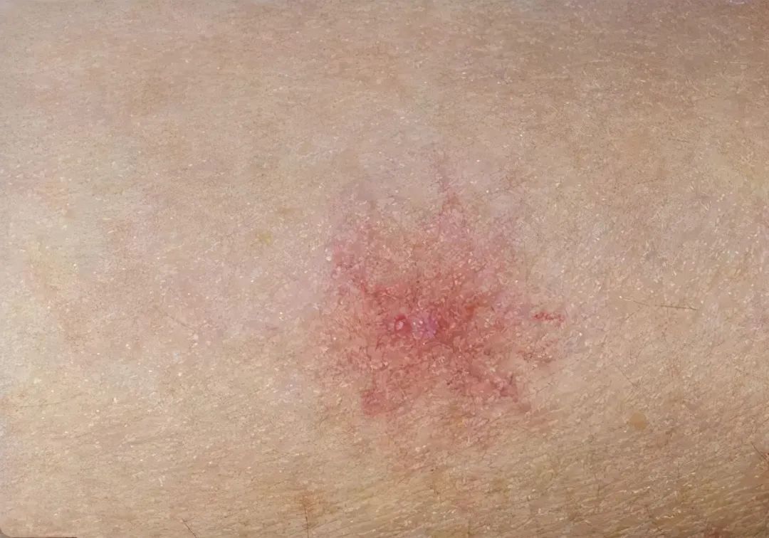 46岁男子,胸前有红点,查出肝硬化,3类人,有异常早检查