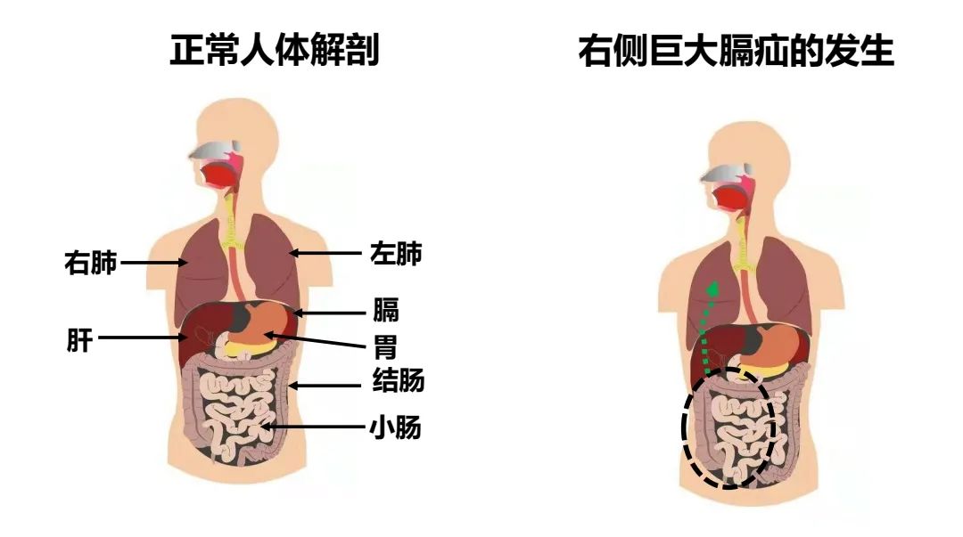 一检查把医生吓一跳,他的小肠,大肠从腹腔跑到了右胸腔,把右肺挤成一