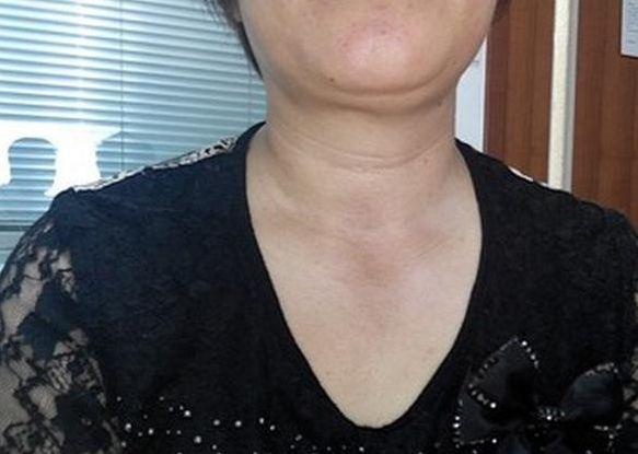 近几年较为常见的结节症状为甲状腺结节,乳腺结节,肺部结节等等,然而