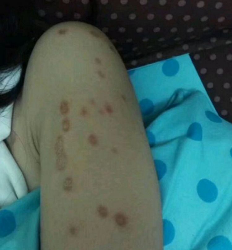 才发现自己的猫咪患上了猫癣,属于皮肤病的一种,特别容易传染给人类