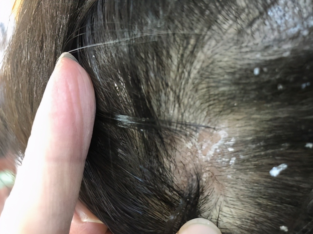 医生一文解释清楚|脂溢性皮炎|头皮|疙瘩_新浪新闻