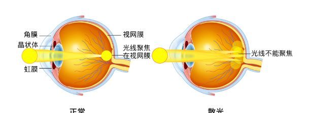 平行光线进入眼内后,由于眼球在各子午线上屈光力不等,不能聚集于一点