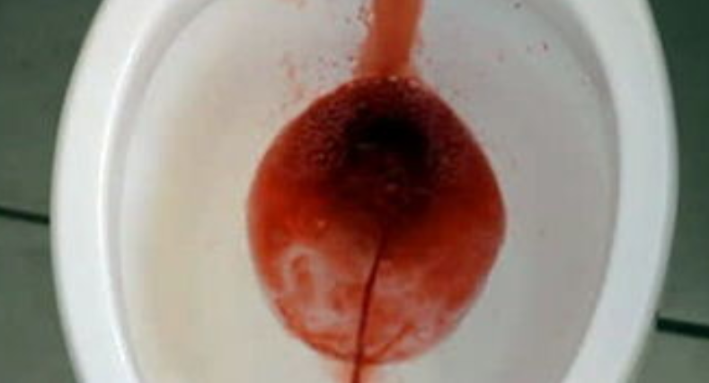 男子不痛不痒突发尿毒症3件事不控制肾早晚要衰竭