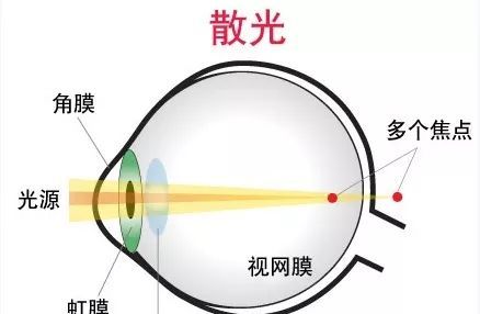 有哪些危害?|散光|散光眼|屈光_新浪新闻