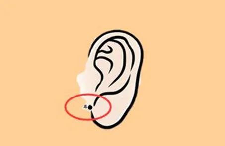 耳根有痣:表示容易生病,点掉也没用,这类人日常要注意养护身体.