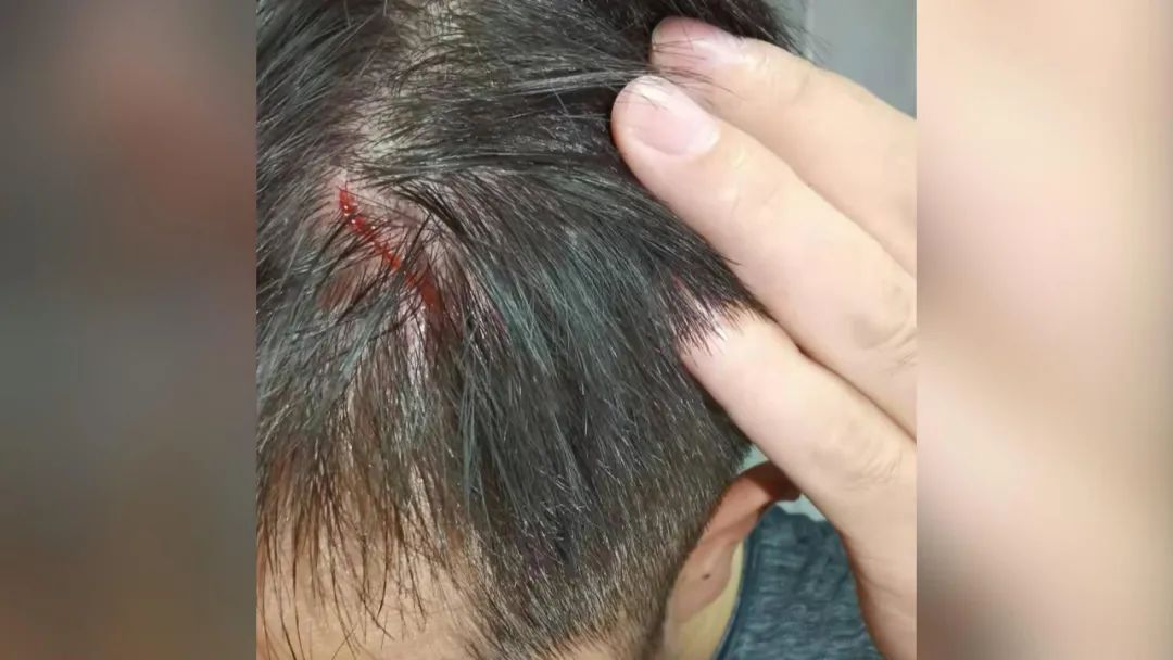撞了头的张大哥也没太在意,拿回餐巾纸后捂了一下头发现出血了.
