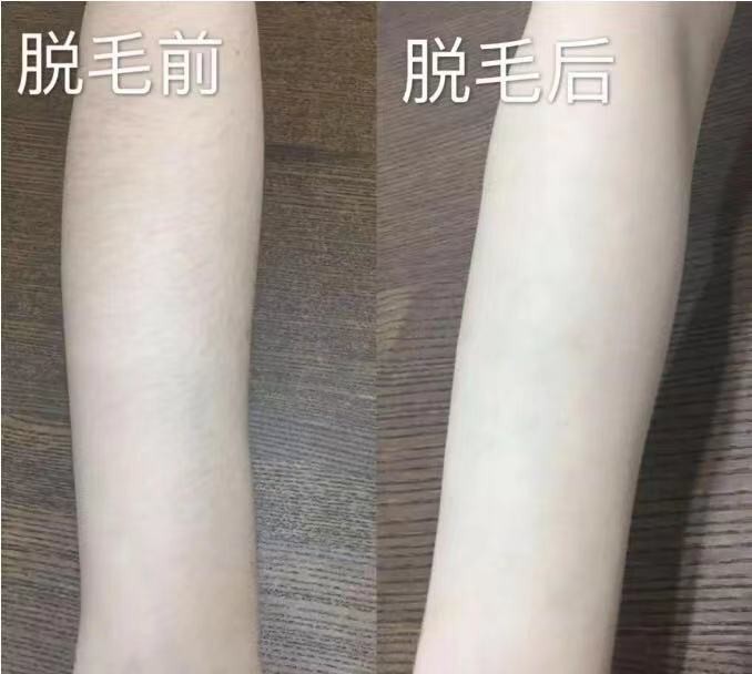 美容院脱毛又贵又疼notime联合华为hilink推出的智能脱毛仪