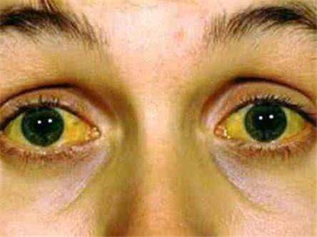 肝坏了,会慢慢"变硬",平时爱做4件事的人,要加倍留心