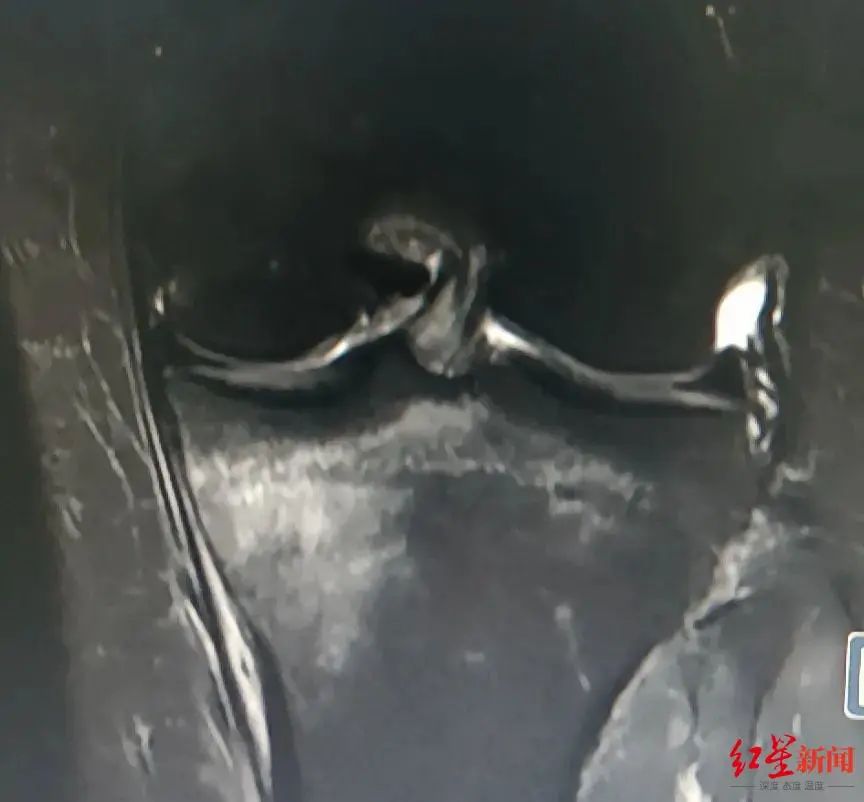 成都30岁女子每天跳绳1000个，万万没想到...休闲区蓝鸢梦想 - Www.slyday.coM