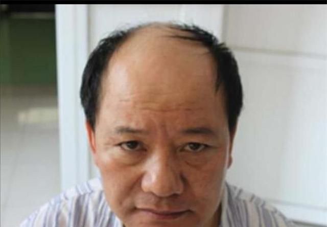 为什么脱发秃顶都只是额头前部头颅周围和后部则很少脱发