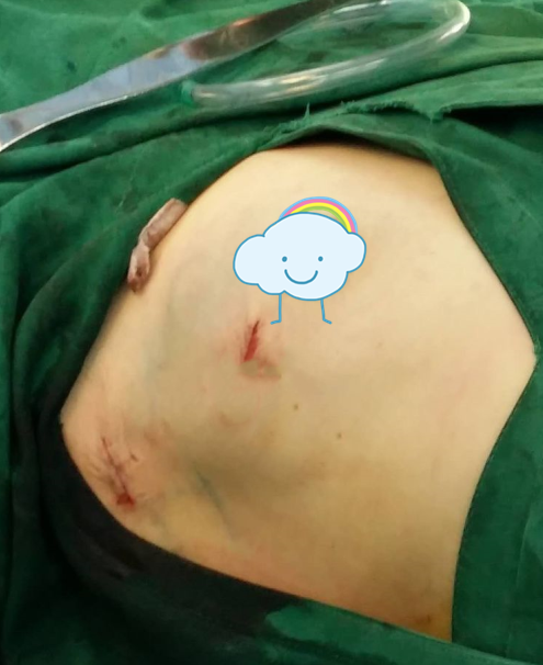 传统的乳腺癌手术会在女性的身体上留下抹不掉的伤痕,严重影响了患者