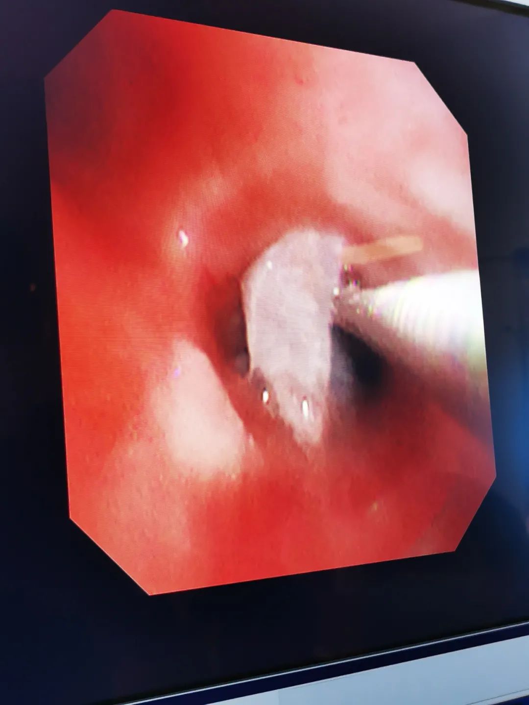 结合过往的诊疗经验,从症状反推原因,张军红考虑,存在气道异物堵塞