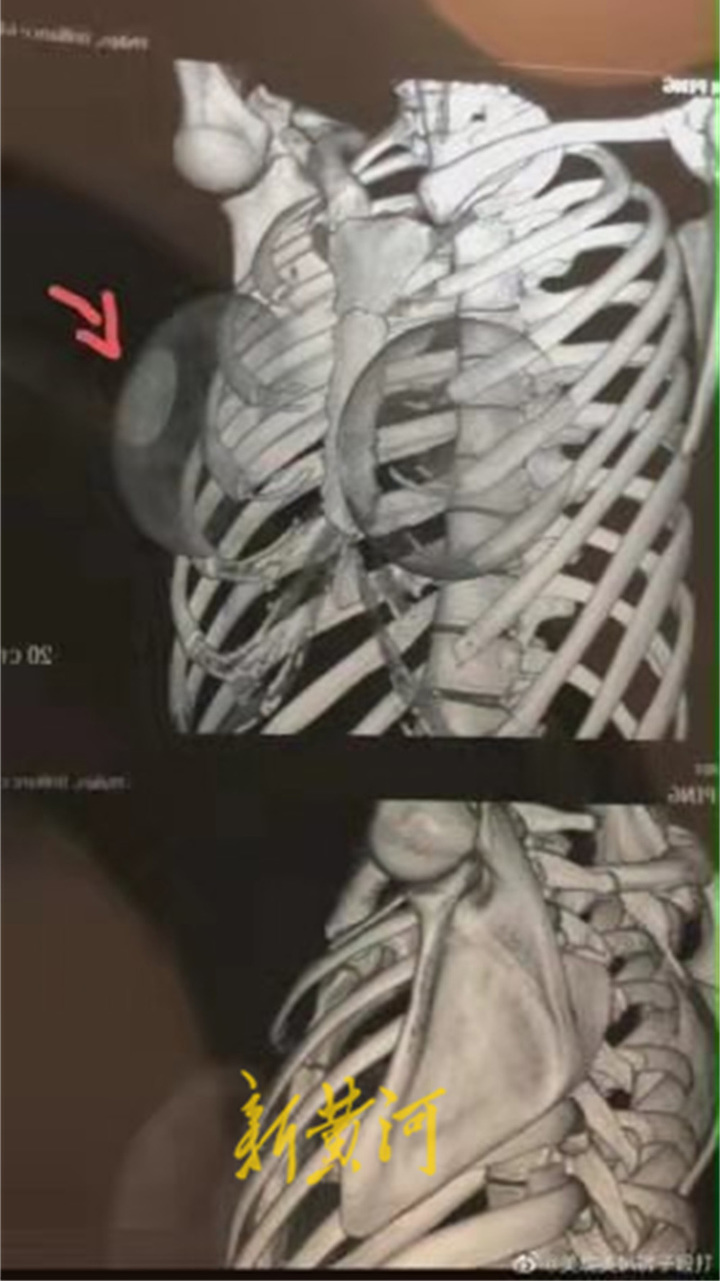 医院出具的CT影像图 受访者供图