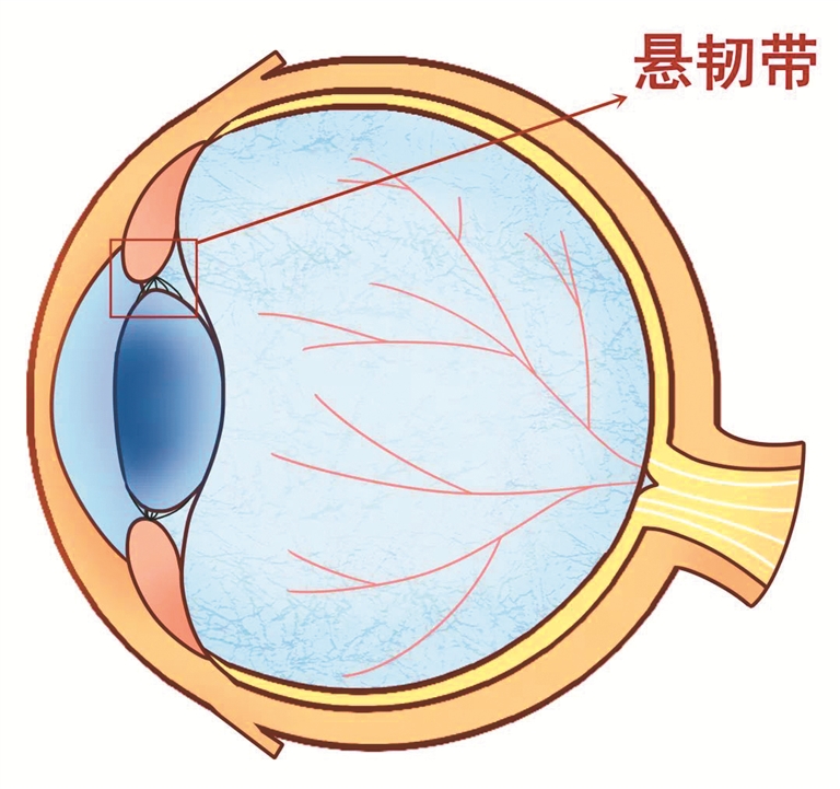 瑜伽动作不当竟导致眼球出血