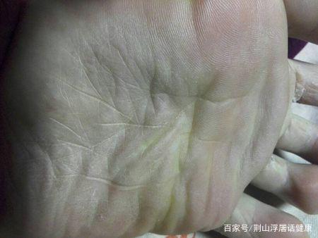 病变,就会造成人体内气血失调,皮肤得不到足够的滋养,就会出现横纹