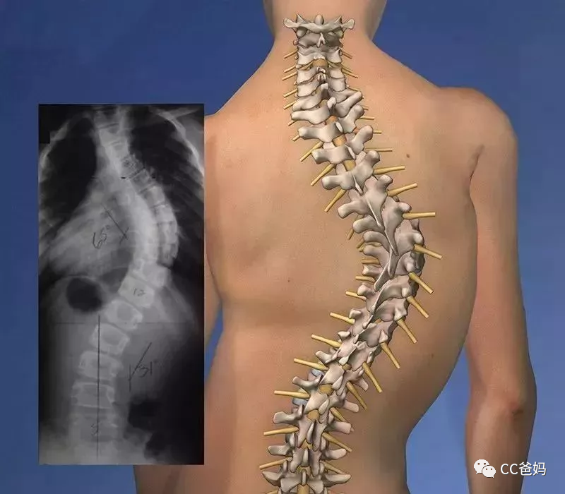 儿童脊椎骨侧弯曲图片图片
