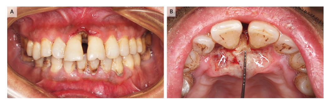 牙齦潰瘍一個月,竟是因為腫瘤!| nejm北京口腔醫院病例
