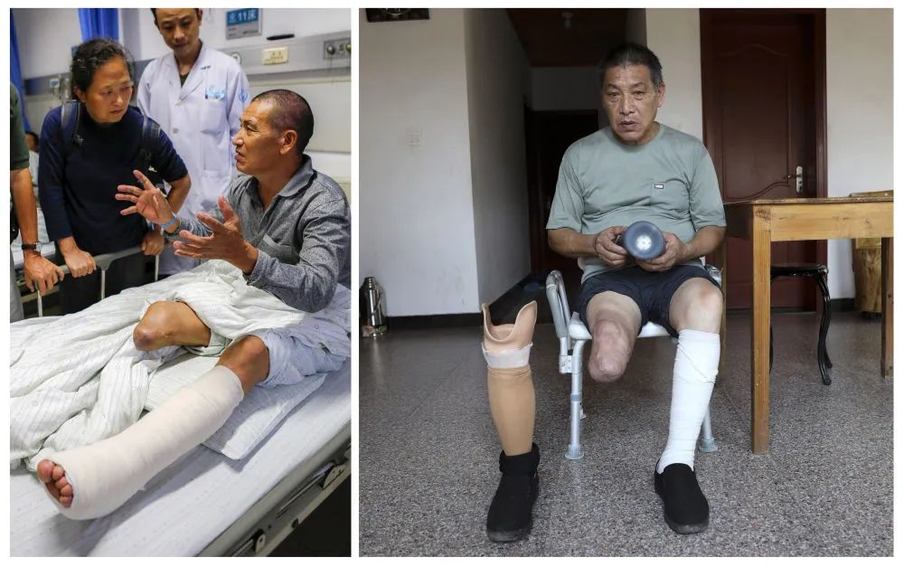 拼版照片:左图为2016年10月24日,姜水根在医院接受截肢手术后与探望