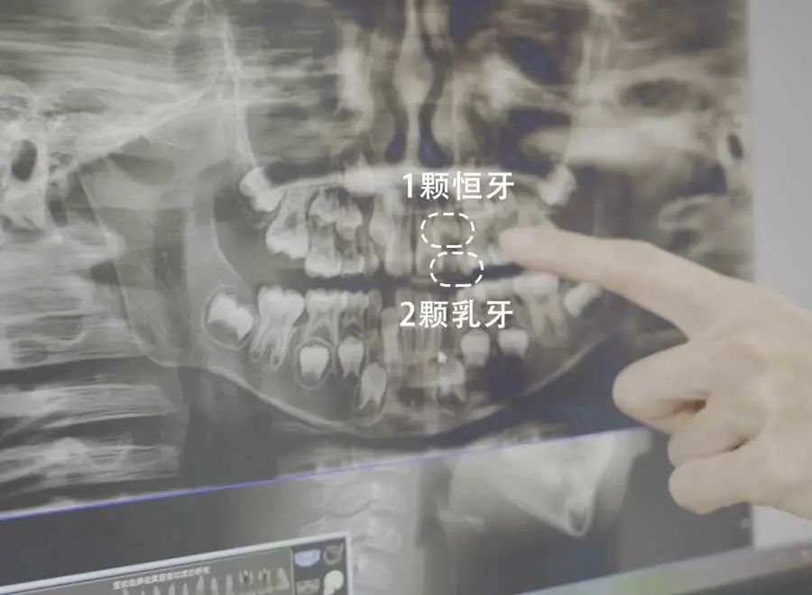 医生给拍了全口 ct,从片子上我们能看出来,一颗恒牙的大小,有两个乳牙