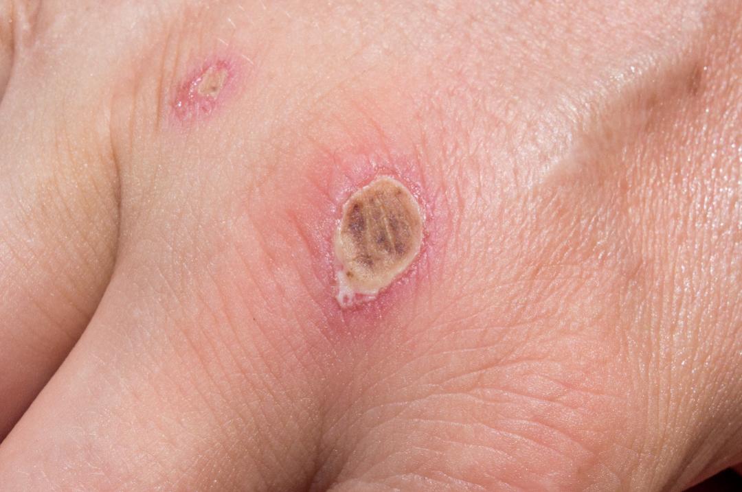 创伤弧菌能够通过身体伤口暴露的部位侵入机体,尽管这些伤口多数时候