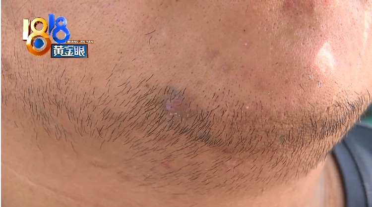 小伙脸上长脓包 “痘院士”强调“有一段时间没来”(图4) 小伙脸上长脓包 “痘院士”强调“有一段时间没来”(图4)