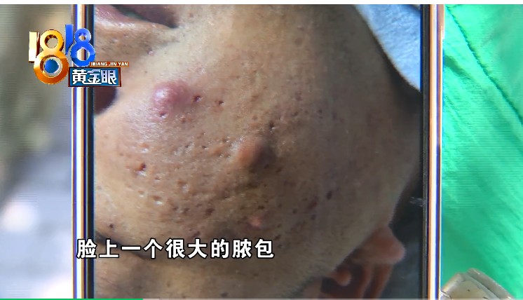 小伙脸上长脓包 “痘院士”强调“有一段时间没来”(图3) 小伙脸上长脓包 “痘院士”强调“有一段时间没来”(图3)