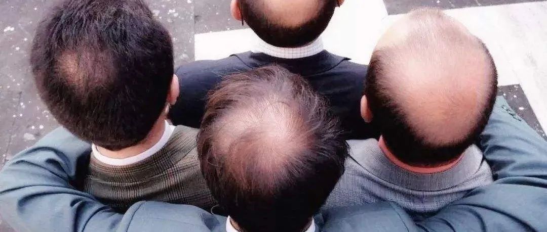 虽然不想认输,可是该秃还得秃|脱发|秃子_新浪新闻