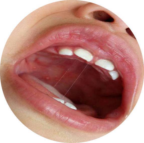 小儿推拿杨晓宝宝得了疱疹性咽峡炎怎么办小儿推拿如何调理