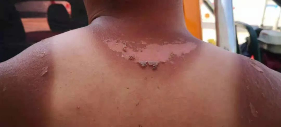 王治勇的后背被晒脱皮(图源:受访者供图)