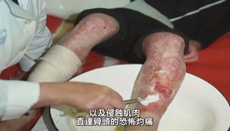 核辐射会带来什么日本职员目睹自己83天不断腐烂求死却遭拒绝