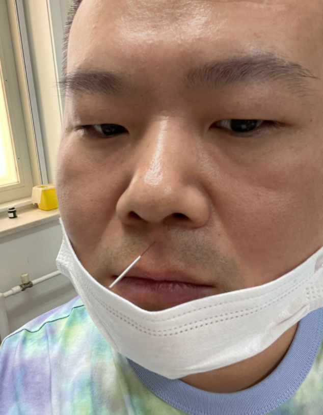岳云鹏扎针灸在人中引爆笑,一脸冷漠不敢动,胡子拉碴嘴唇干燥|针灸
