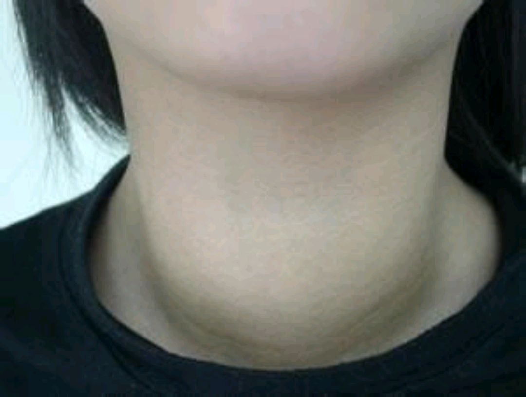 由于以前的人们缺碘,甲状腺容易出现问题,得"大脖子"病.