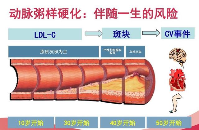 预防动脉粥样硬化性心血管疾病如何合理使用他汀