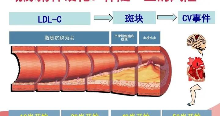 动脉粥样硬化和高血压的脑动脉病变有什么不同 高血压和动脉粥样硬化有什么关系