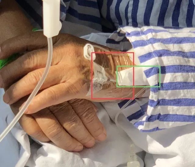 留置针贴膜到底怎么贴90护士都错了