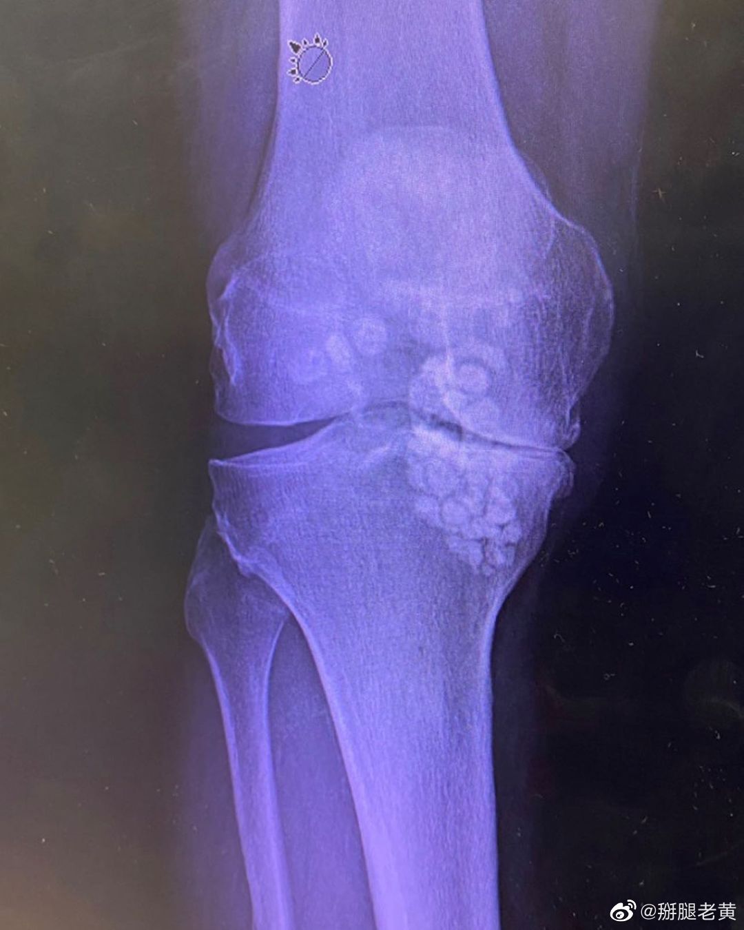膝关节滑膜软骨瘤病,需要手术取出,同时配合滑膜切除