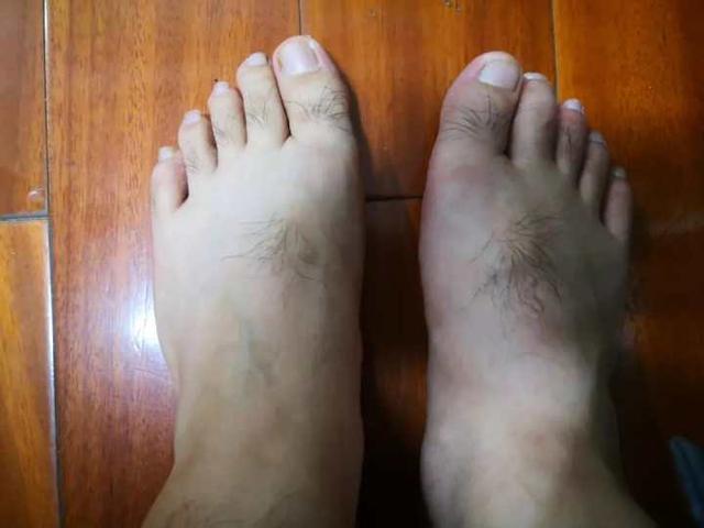 3口海鲜下肚，90后小伙痛到不能走路，为何痛风年轻化？医生一语道破真相休闲区蓝鸢梦想 - Www.slyday.coM