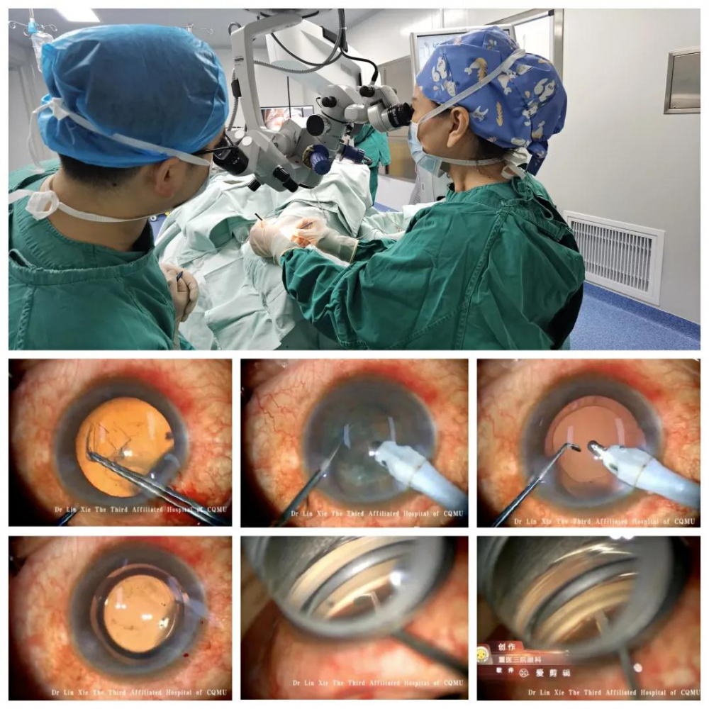 一箭双雕附三院眼科在重庆率先开展微创抗青光眼手术联合白内障手术