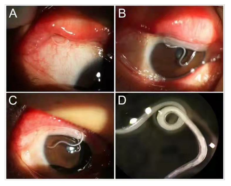 眼睛痒查出寄生虫可能和养狗有关汕头国际眼科中心nejm发表病例