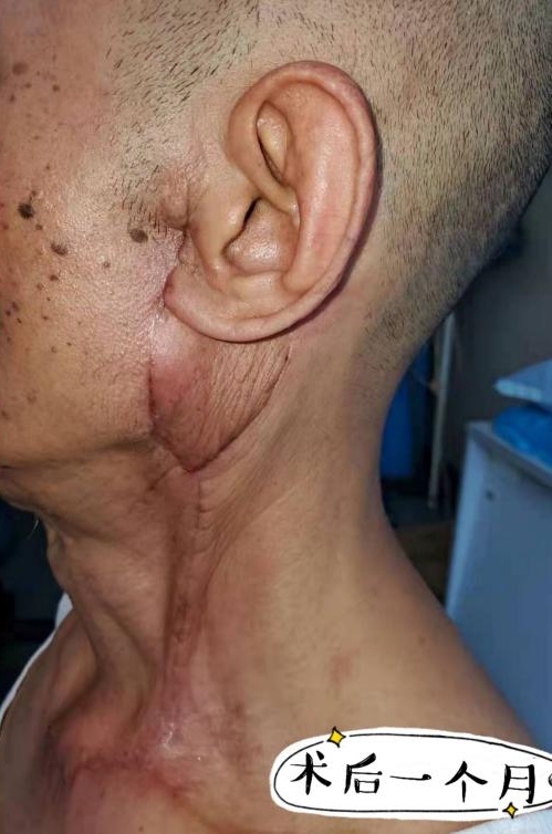 发现腮腺肿块要注意耳后长土豆20多年竟成癌