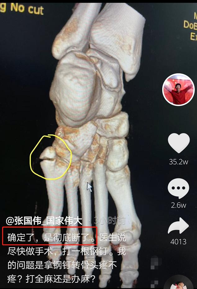 张国伟还晒出了左脚ct照片,骨头中间出现了一条明显的裂痕.
