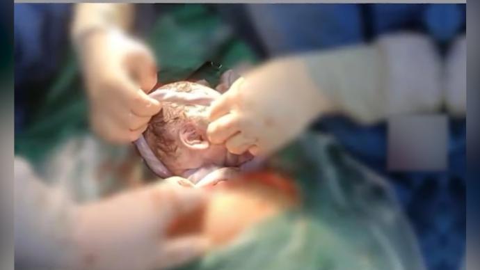 二胎宝宝出生时脐带绕颈6圈,长度达116厘米_手机新浪网