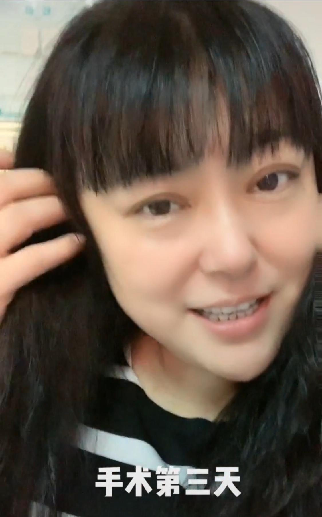 目前已完成手术,脸型消瘦惹粉丝心疼|李菁菁|脸型|乳腺癌_新浪新闻