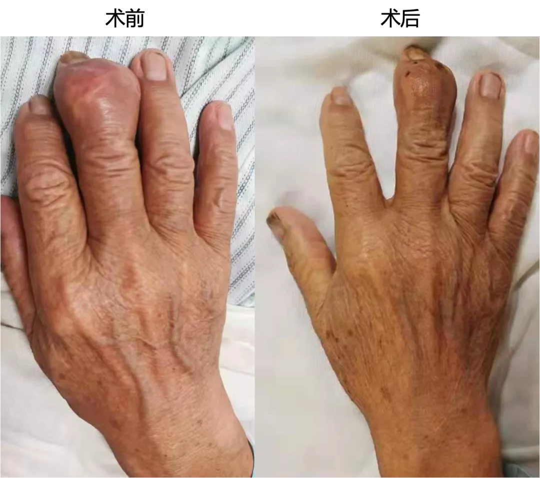 男子膝关节里长出了"钟乳石"|关节|痛风石|痛风_新浪新闻